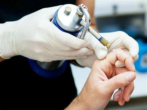 Как избавиться от бородавки | MedAdvisor