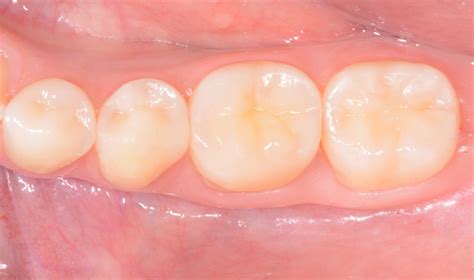 Adhesive Management of Worn Dentition Using the “Index Technique” The
