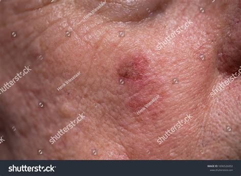 Hyperkeratose : images, photos et images vectorielles de stock ...