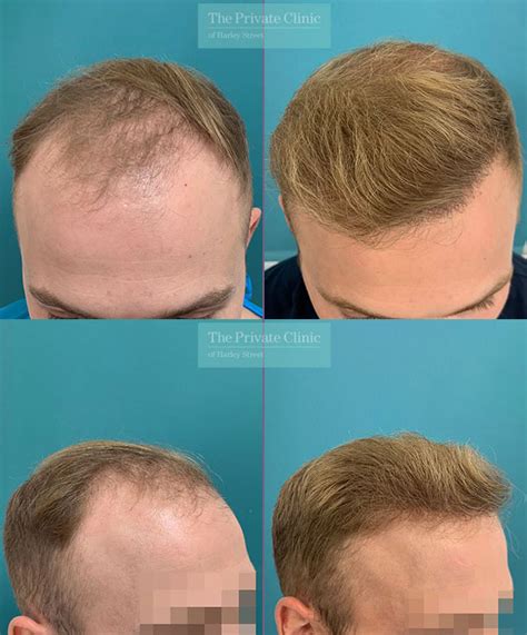 dr furqan raja shortlisted  uks  hair transplant surgeon