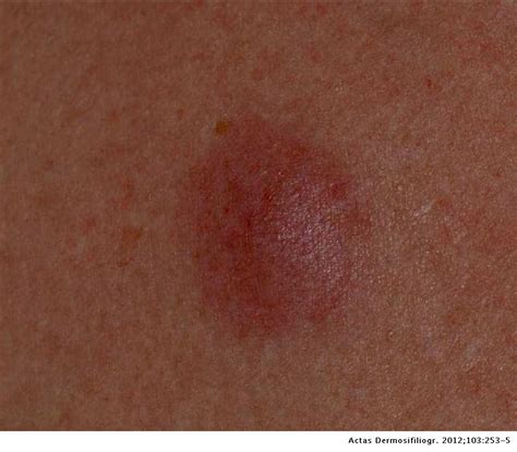Systemic Follicular Lymphoma With Cutaneous Manifestations and ...