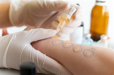 perlukah tes alergi  detail info  manfaatnya prosix