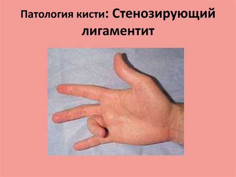 Патология кисти - презентация онлайн