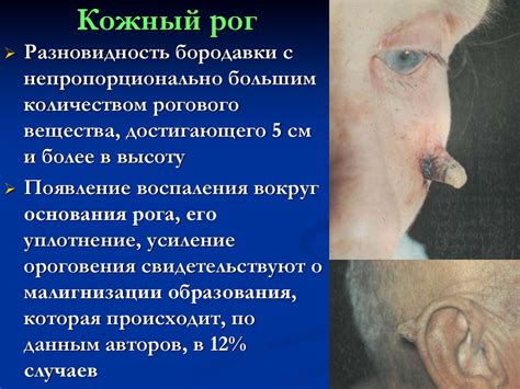 Злокачественные новообразования кожи - online presentation