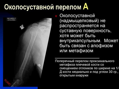 Переломы плечевой кости - презентация онлайн