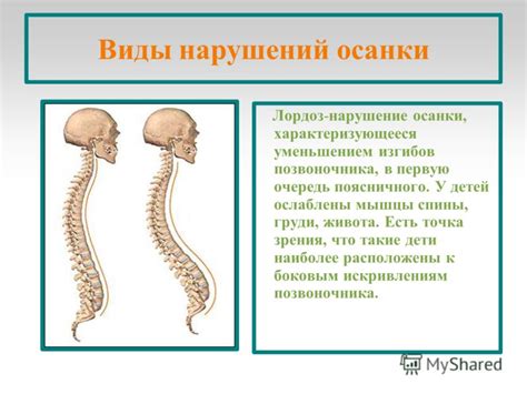 Презентация на тему: "Нарушение осанки у дошкольников. Цели ...