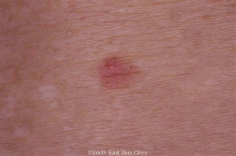 BCC (Basal Cell Carcinoma)
