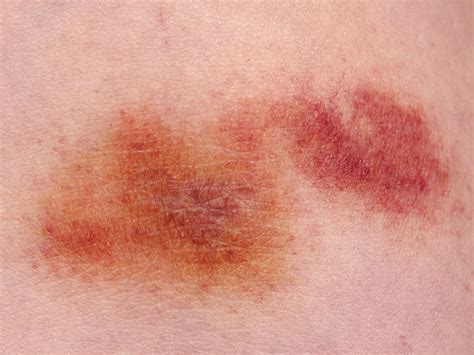 Inflammatory Breast Cancer Bruise
