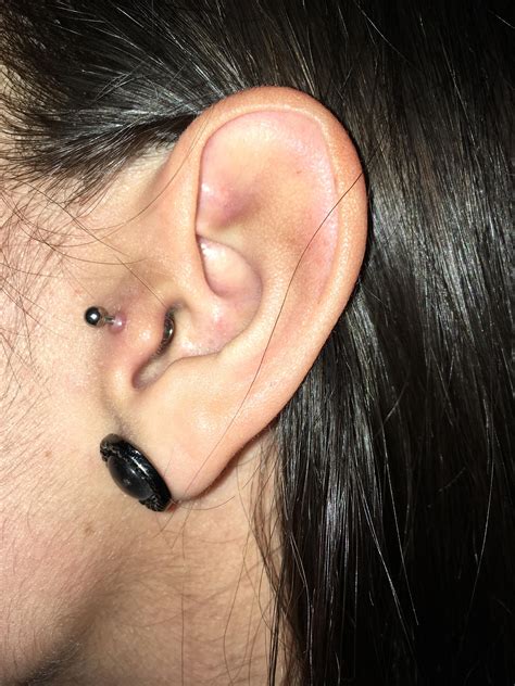 Hypertrophic Scar Tragus Piercing