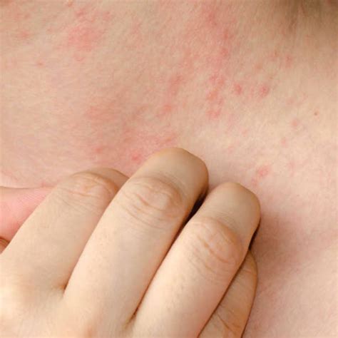 Alergia A Camarão Sintomas - Alergia De Camarão Na Pele - NAZAEDU