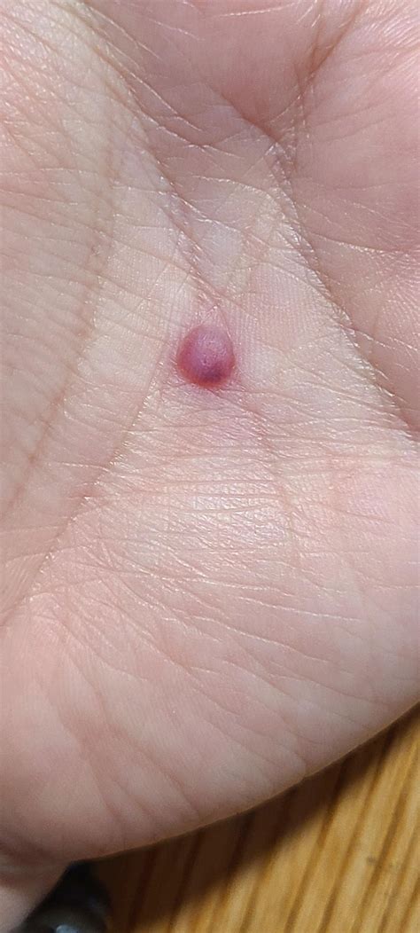 Small wart on my palm : r/Warts