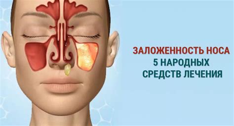 Лечение синусита дома народными средствами