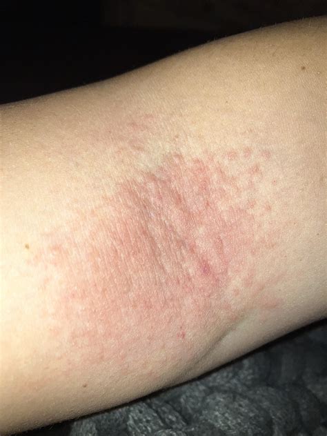 Developing a rash on my arm (inside part, where it bends) : r/Ozempic