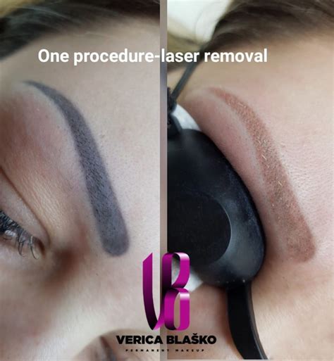 Lasersko uklanjanje trajne šminke obrva – Verica Blasko