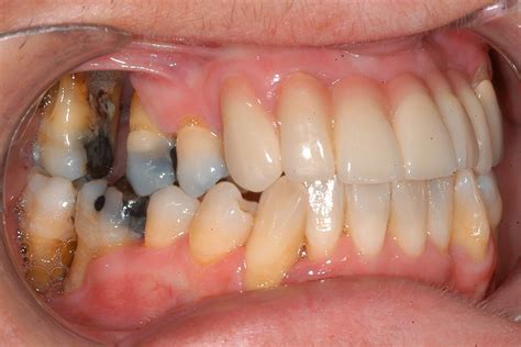 40 Facts About Periodontal Ehlers-Danlos Syndrome - Facts.net