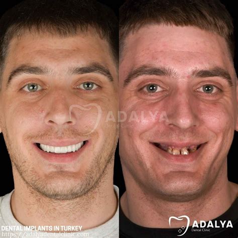 Tooth Implant Turkey Price 2026 - Affordable Tooth Implants Cost