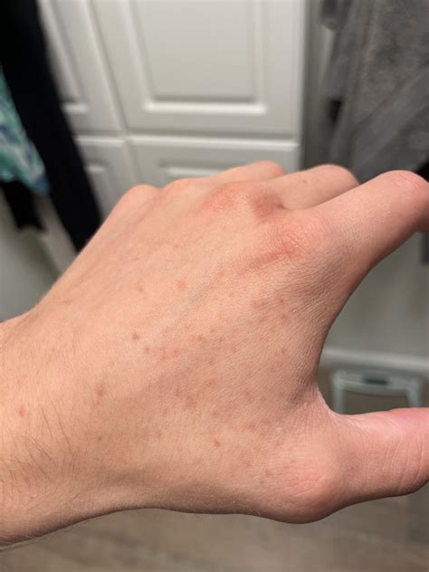 These bumps have exist for weeks (No great itch or red spots) What are