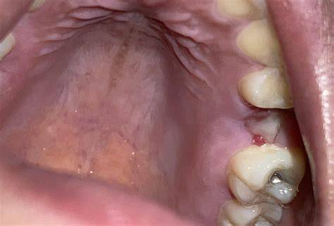 My tooth extraction site has begun hurting a little. I had a little bit