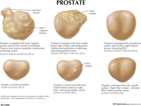 Digital rectal examination for prostate cancer screening performed with