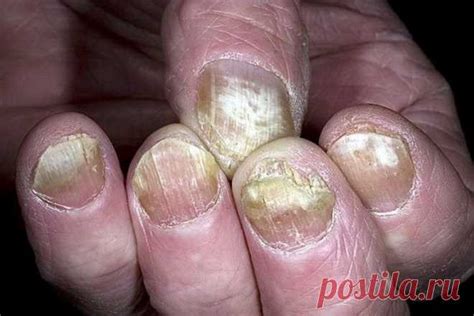Мазь ловка против грибка - Советы и Рецепты Грибок на ногтях или пальц ...
