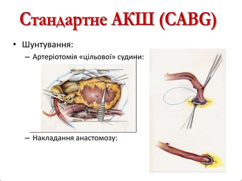 Аорто-коронарне шунтування - презентация онлайн