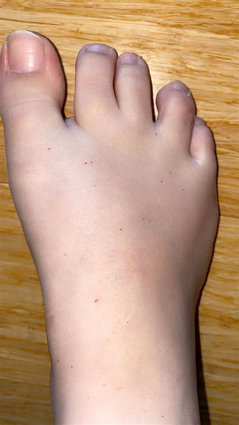 red dots on feet : r/DermatologyQuestions