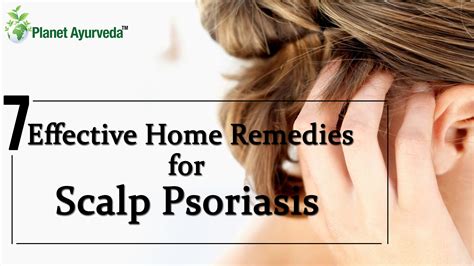 7 Effective Home Remedies for Scalp Psoriasis