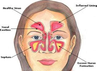 Causes of Nasal Congestion and its management - teatreeoiluses9