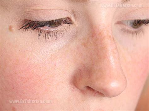 Bony nose surgery - How we can correct the nasal bump?