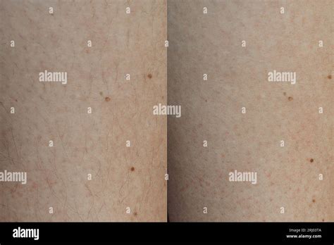 concept  sugaring hair removal procedure  sugar paste