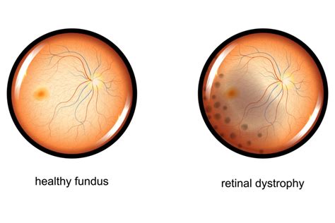 Retinal Dystrophies: Causes, Symptoms and Treatments | MyVision.org