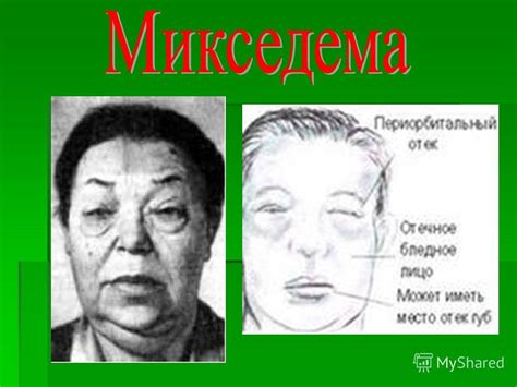 Презентация на тему: "Микседема (от греч. mýxa - слизь и óidēma ...