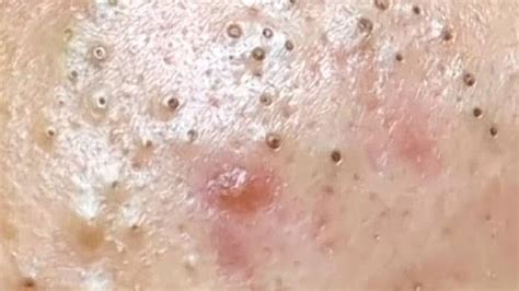 Blackheads Neu 2025 - Tara Zulema