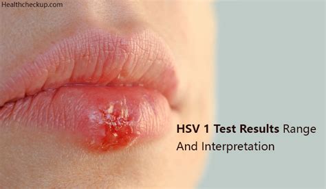 HSV 1 Test Results Range And Interpretation - Health CheckUp