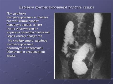 Лучевая диагностика заболеваний органов пищеварения - презентация онлайн