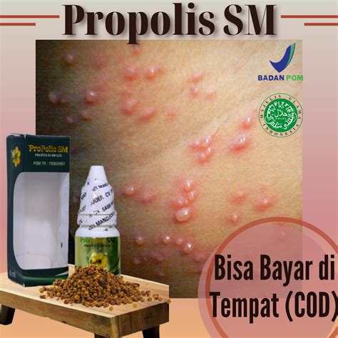 jual obat cacar air cacar api kudis infeksi jamur bekas cacar ruam
