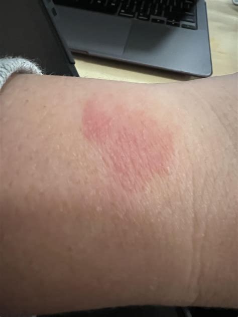 Sudden Allergy!! : r/Polarfitness