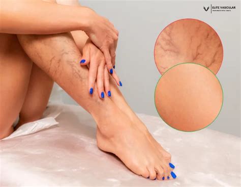 Benefits of Venous Insufficiency Treatment