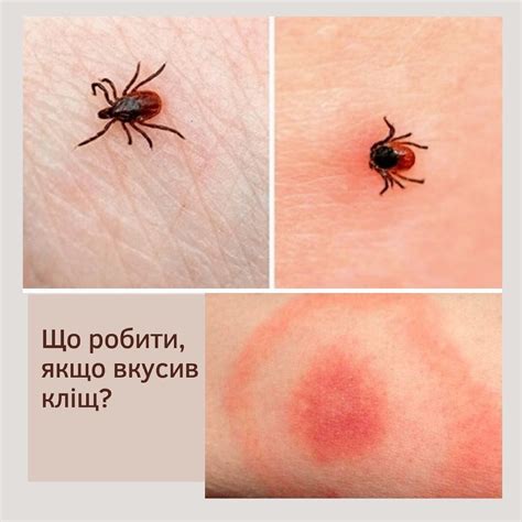 Властамед - Від укусів кліщів щорічно страждають сотні тисяч людей, які ...
