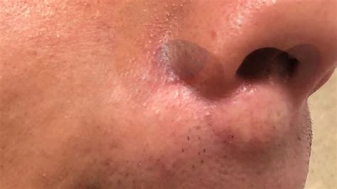 Sebaceous Cyst