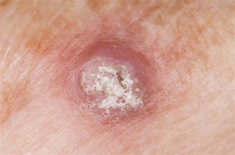 Keratoacanthoma on the skin - Stock Image - C009/0079 - Science Photo ...