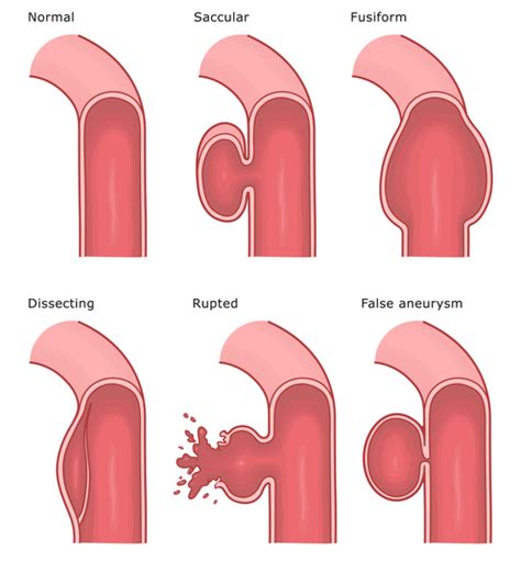 understanding  types  brain aneurysms supreme vascular  interventional clinic