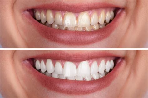 Smile On A Budget: The Shocking Truth About Professional Teeth Whitening Prices