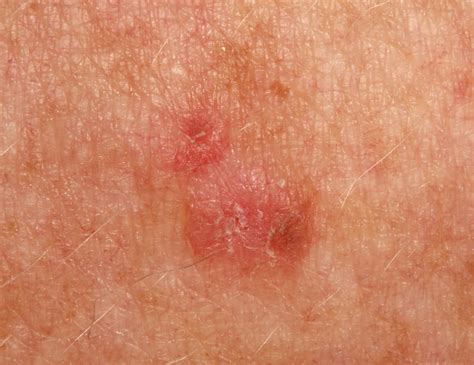 Actinic Keratosis Causes Symptoms Actinic Keratosis Treatment Images