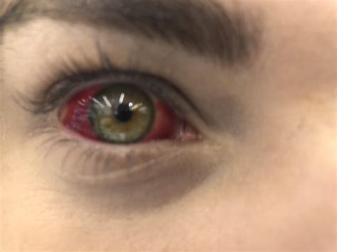 My friend has a burst blood vessel in her eye 😱 : r/eyes