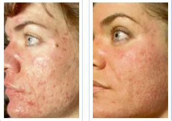 chemical peel acne scars