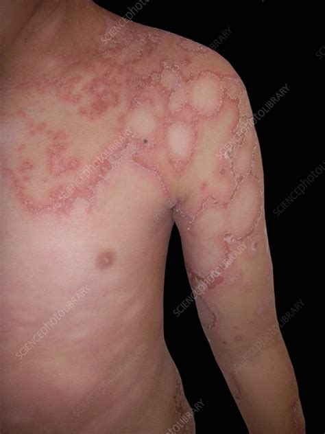 Pustular psoriasis - Stock Image - C048/2947 - Science Photo Library