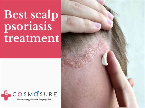 Best Scalp Psoriasis Treatment | Cosmosure Clinic