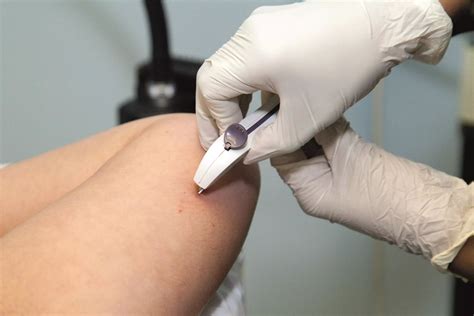 Birth Control Implant