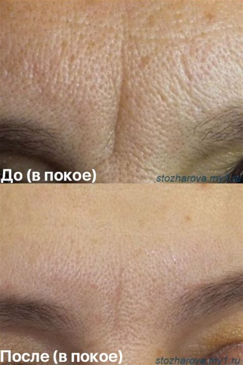 Ботулинотерапия - цены в Санкт-Петербурге в клинике ГАЛАКТИКА